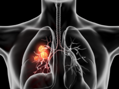 Llega “Sotorasib”, molécula innovadora para el tratamiento de cáncer de pulmón de células no pequeñas